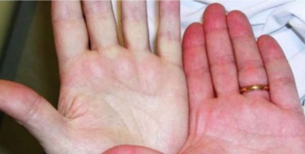 نشانه‌های «پُرخونی» چیست؟