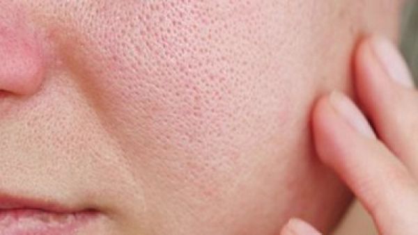 راهکارهای طبیعی برای از بین بردن قرمزی صورت